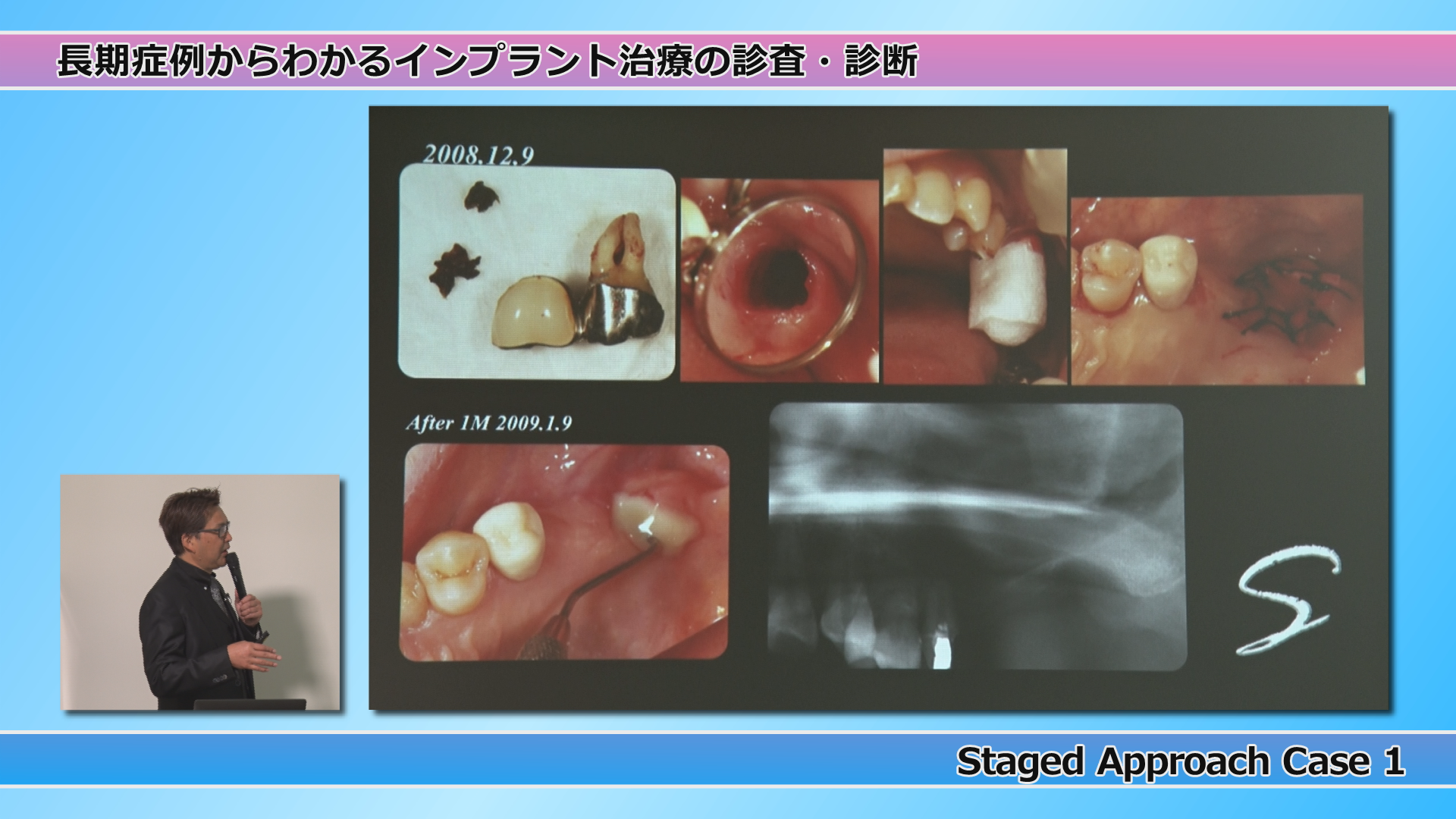 SBC Sinus Approach Course (SAC)【全4巻・分売不可】 SBC Sinus